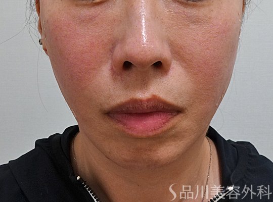 症例NO.75009のAFTER写真
