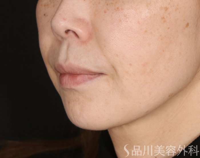 症例NO.73411のBEFORE写真