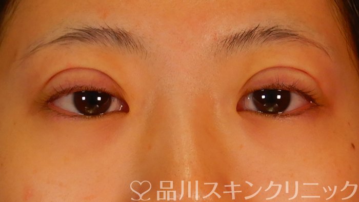 症例NO.69209のAFTER写真