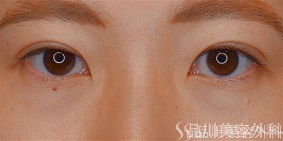 症例NO.72321のAFTER写真