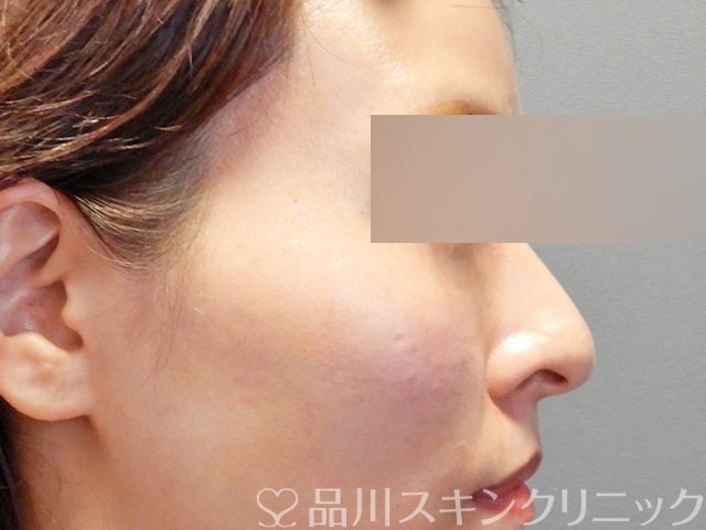 症例NO.67974のAFTER写真