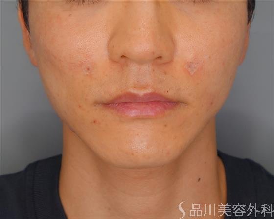 症例NO.53173のAFTER写真