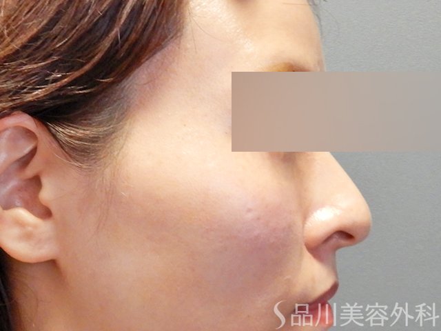 症例NO.67974のAFTER写真
