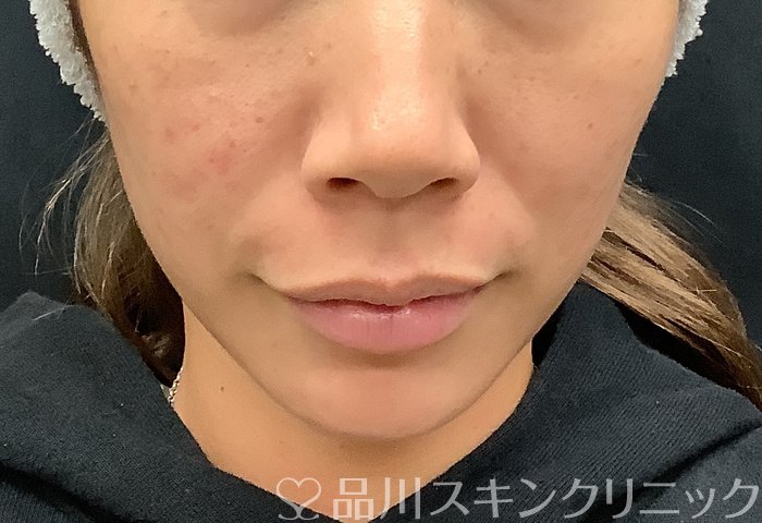 症例NO.67961のBEFORE写真