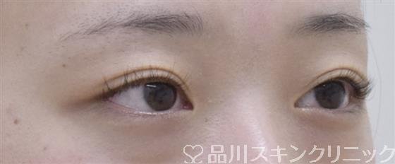 症例NO.52541のBEFORE写真