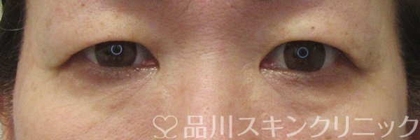 症例NO.71224のBEFORE写真