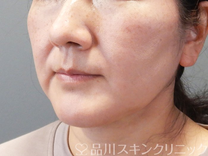症例NO.74189のBEFORE写真