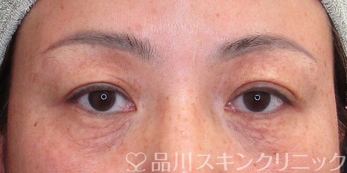 症例NO.73645のBEFORE写真