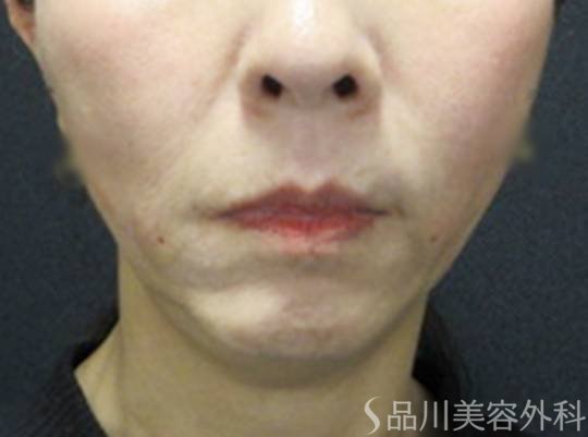 症例NO.72478のAFTER写真