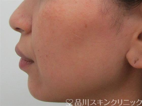 症例NO.31860のBEFORE写真