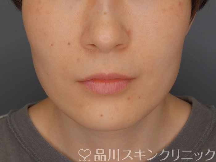 症例NO.71490のBEFORE写真