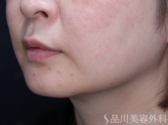 症例NO.69520のBEFORE写真