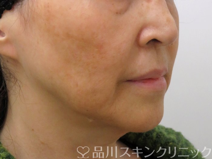 症例NO.73763のBEFORE写真