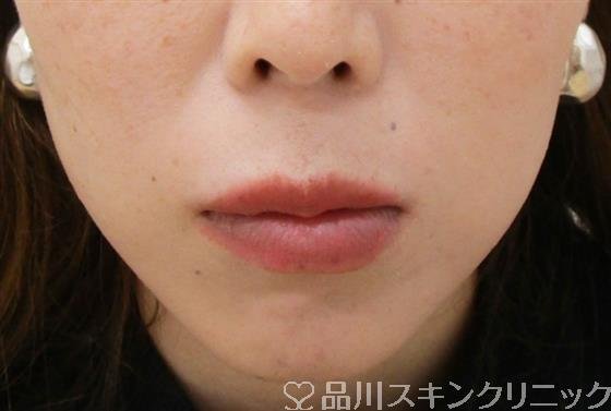 症例NO.37530のBEFORE写真