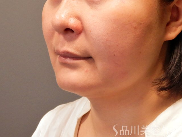 症例NO.70314のAFTER写真