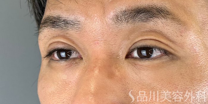 症例NO.70620のAFTER写真