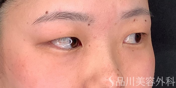 症例NO.71234のBEFORE写真