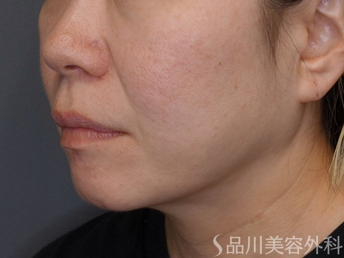 症例NO.74944のBEFORE写真