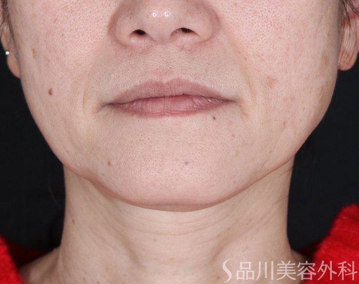 症例NO.72644のBEFORE写真