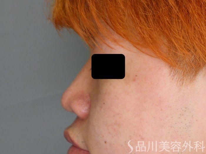 症例NO.75050のBEFORE写真