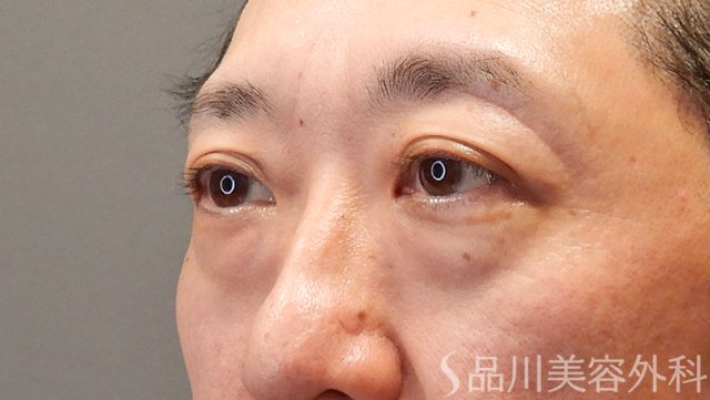 症例NO.74560のBEFORE写真