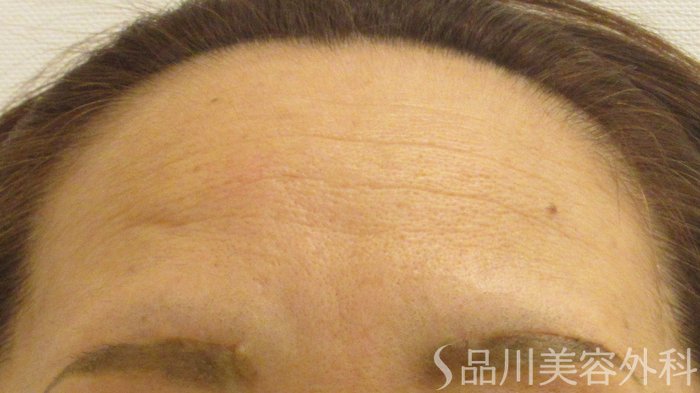 症例NO.71906のBEFORE写真
