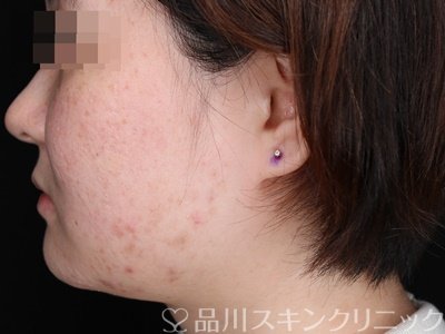 症例NO.73338のBEFORE写真