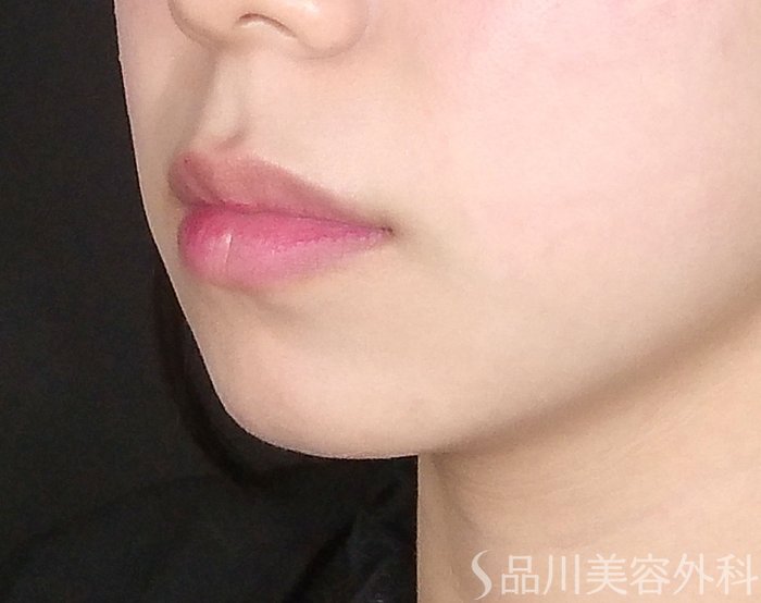 症例NO.65372のBEFORE写真