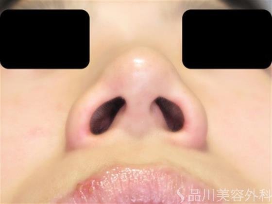 症例NO.49491のBEFORE写真