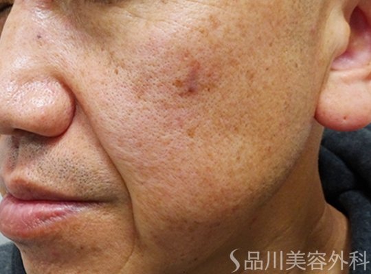 症例NO.70889のBEFORE写真
