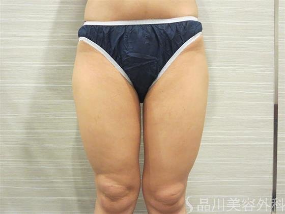 症例NO.20559のAFTER写真