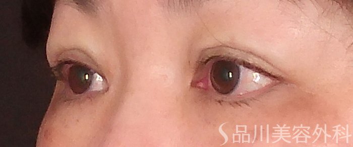 症例NO.70481のAFTER写真