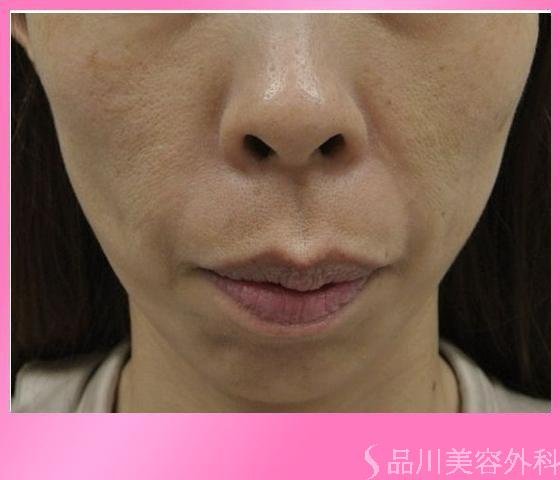 症例NO.11642のBEFORE写真