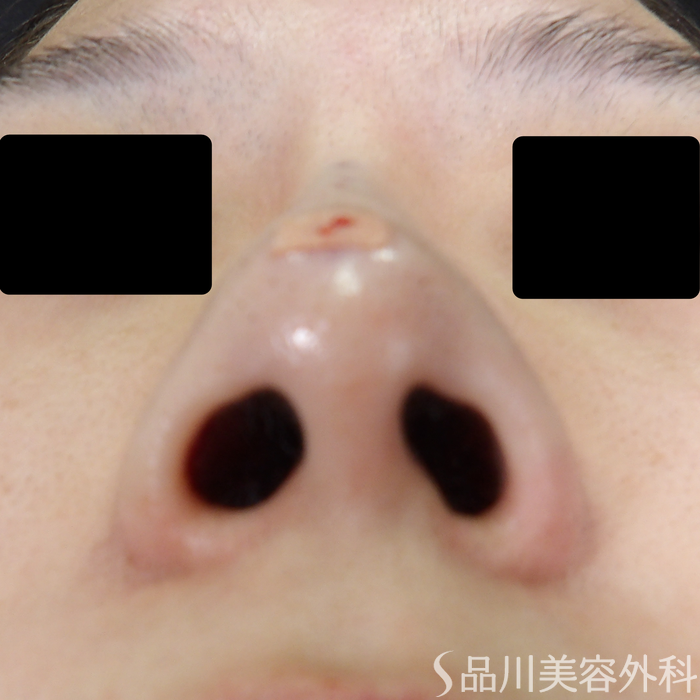 症例NO.70926のAFTER写真
