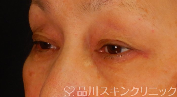 症例NO.67398のBEFORE写真