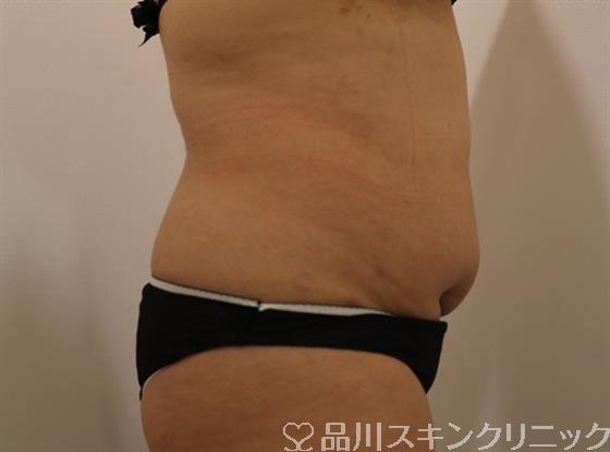 症例NO.42499のAFTER写真