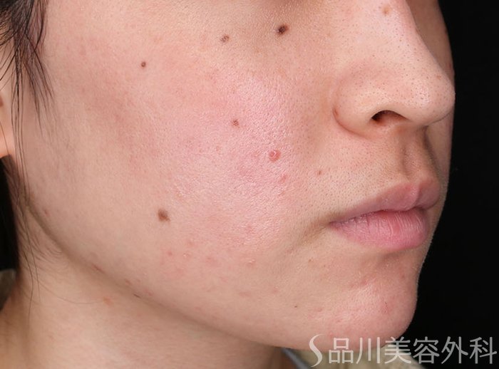 症例NO.73059のBEFORE写真