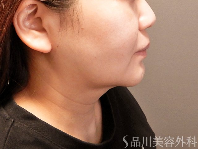 症例NO.69394のBEFORE写真