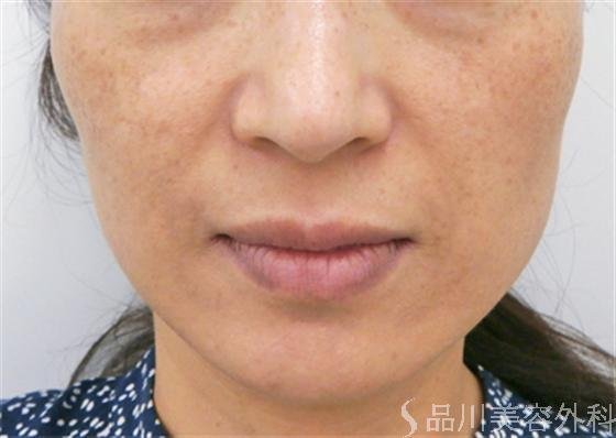 症例NO.18139のBEFORE写真