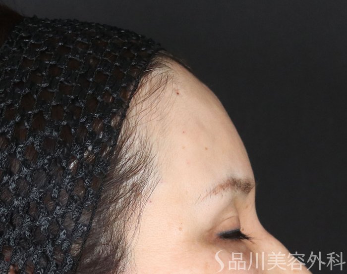 症例NO.73055のAFTER写真