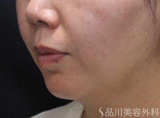 症例NO.75104のBEFORE写真