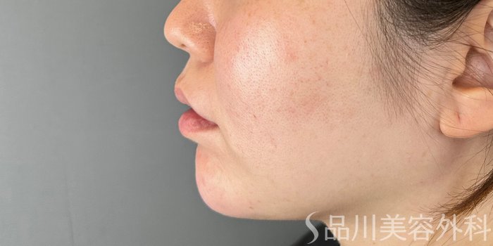 症例NO.73011のAFTER写真