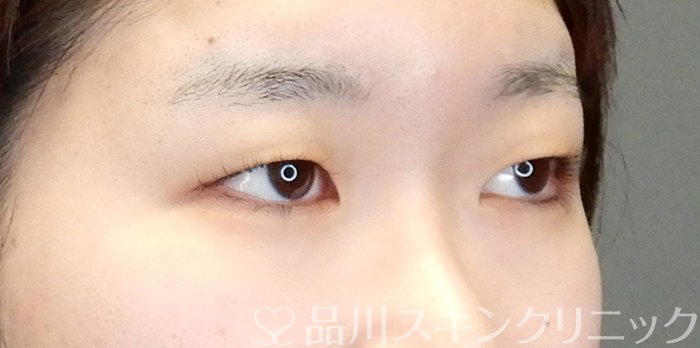 症例NO.63523のBEFORE写真