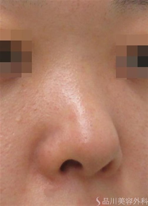 症例NO.23856のBEFORE写真