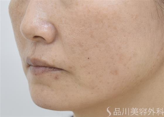 症例NO.44024のAFTER写真