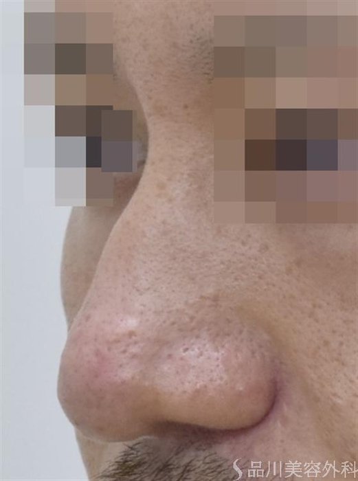 症例NO.48136のAFTER写真