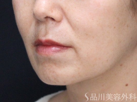 症例NO.73385のAFTER写真