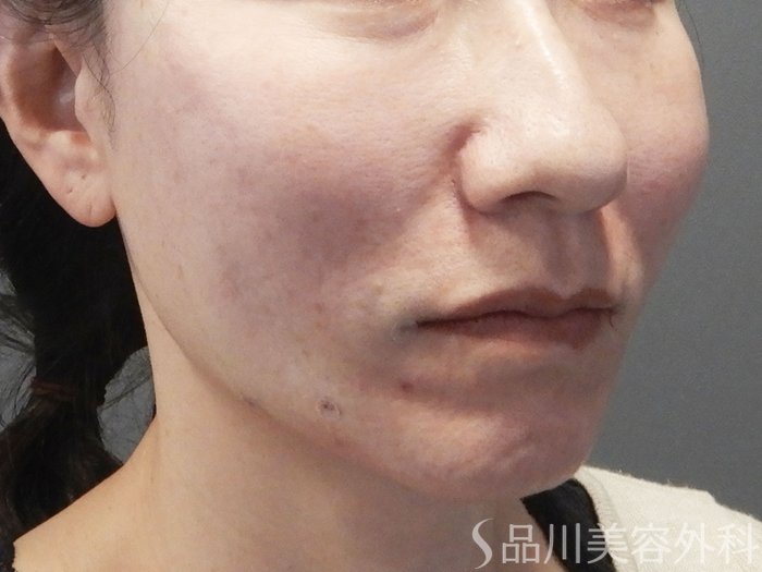 症例NO.72103のAFTER写真