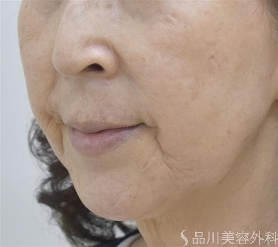 症例NO.53688のBEFORE写真