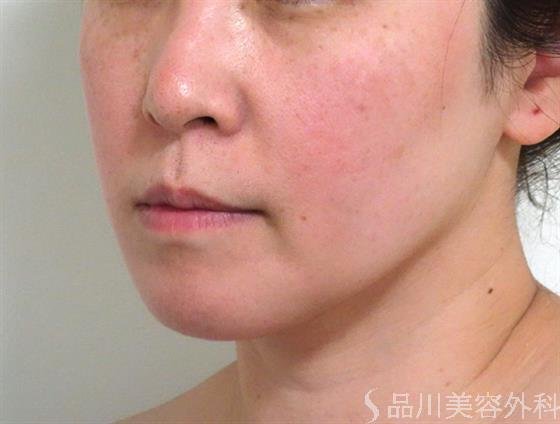 症例NO.35169のBEFORE写真